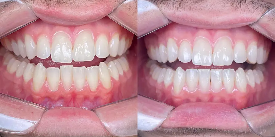 Alinhadores SouSmile em exposição